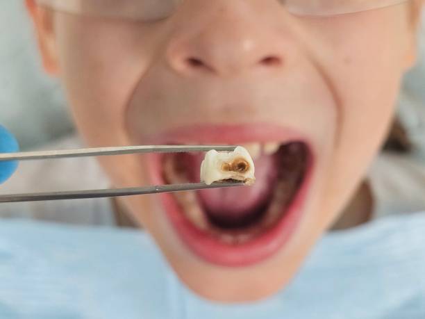 Best Emergency Wisdom Teeth Removal in Potomac Heights, MD